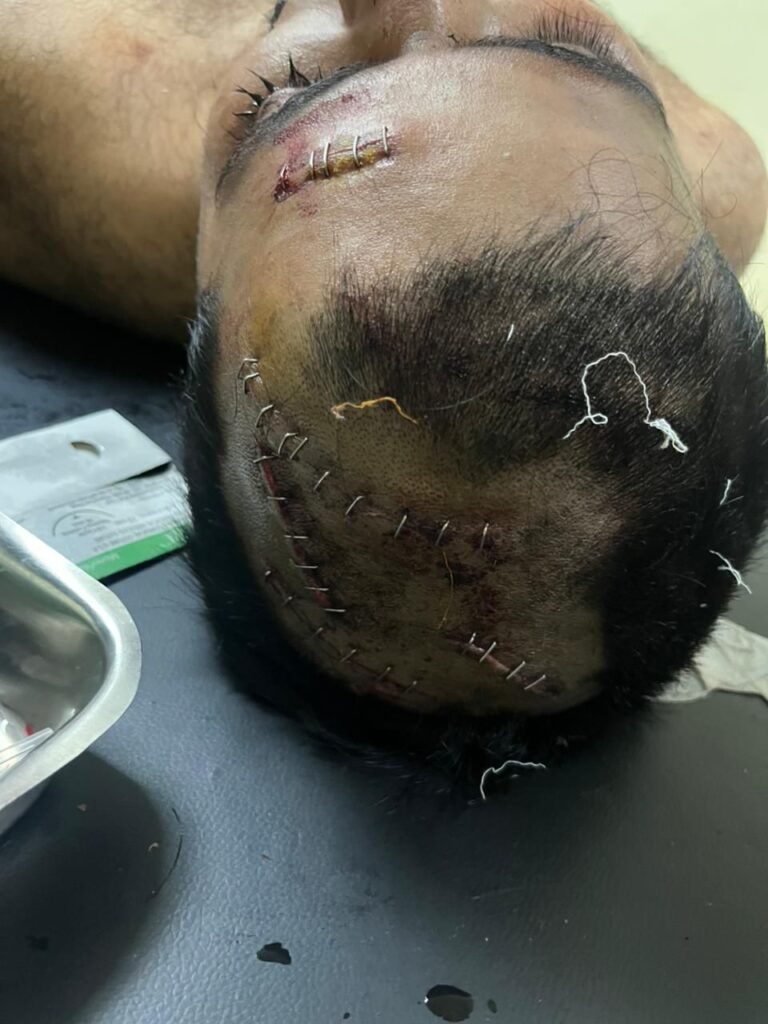 शिरुर मधील तरुणावर पूर्ववैमनस्यातून प्राणघातक हल्ला केला गेला आहे.त्यासाठी  4 लाख रुपयांची 'सुपारी' दिली होती ?,अशी माहिती मिळाली आहे. (पहा सी सी टी व्ही फुटेजसह) ही शिरुर शहरात पुन्हा थरकाप उडवणारी घटना दिनांक 30/09/2024 रोजी सकाळी 9:30 वाजता घडली आहे. यात कोयता व पिस्तोल यांचा वापर करण्यात आला आहे. 